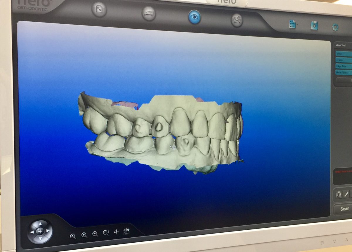 invisalign treatment update snellville ga orthodontist Gray Orthodontics