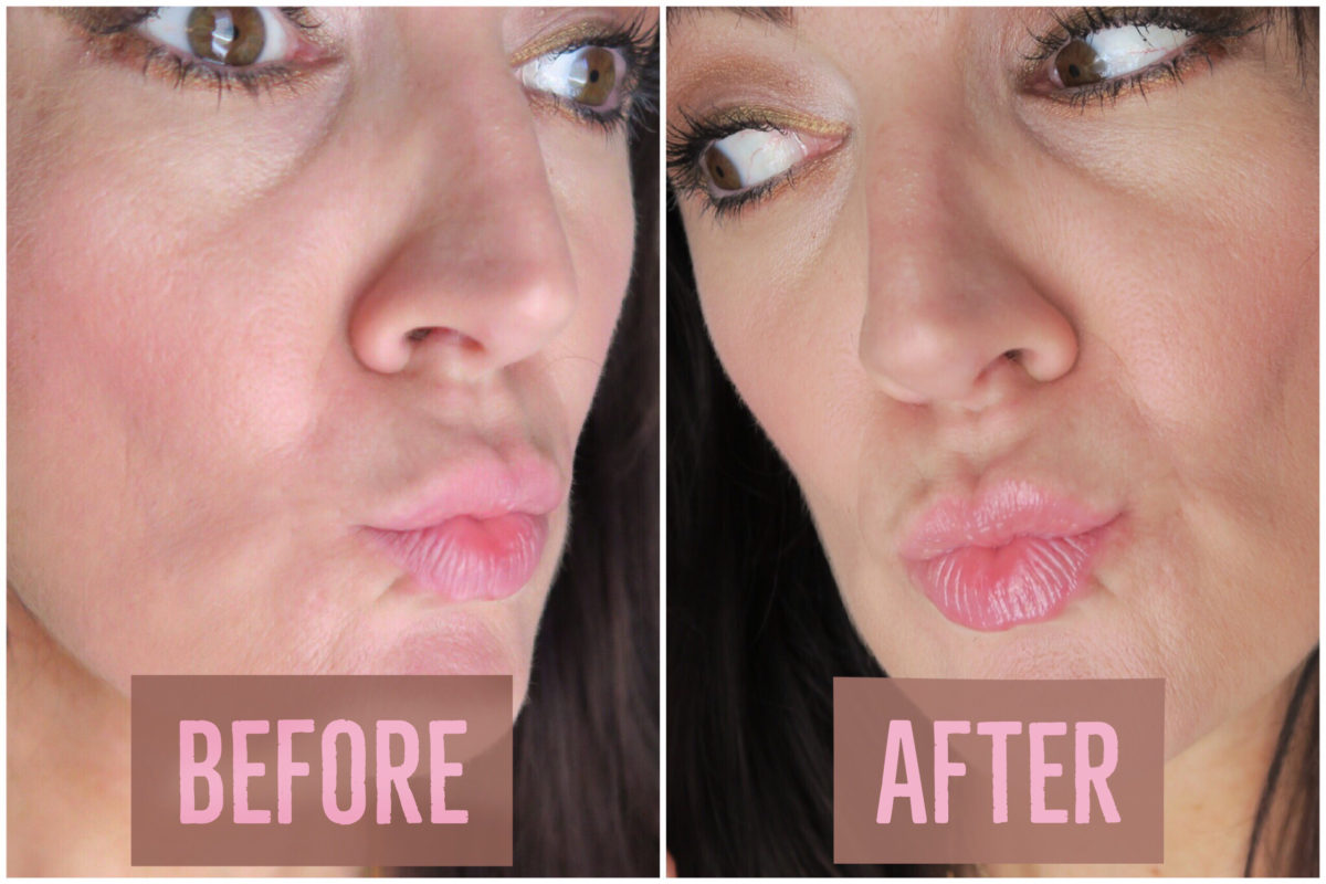 fuller lips without lip injections