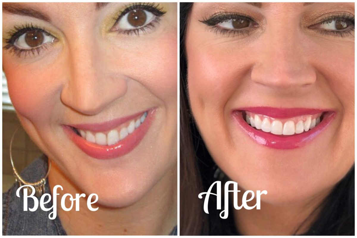 Invisalign before and after treatment