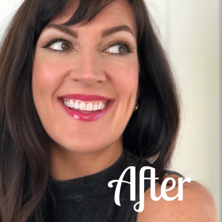 Invisalign Treatment Wrap Up Video + Before And Afters