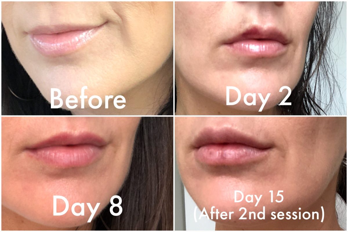How To Make Lip Filler Bruising Go Down