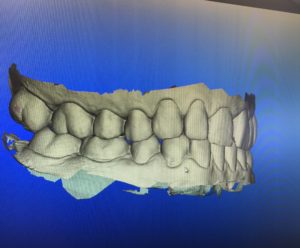 invisalign_teeth_scan