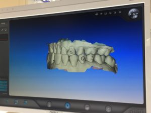 invisalign treatment update snellville ga orthodontics Mark Gray