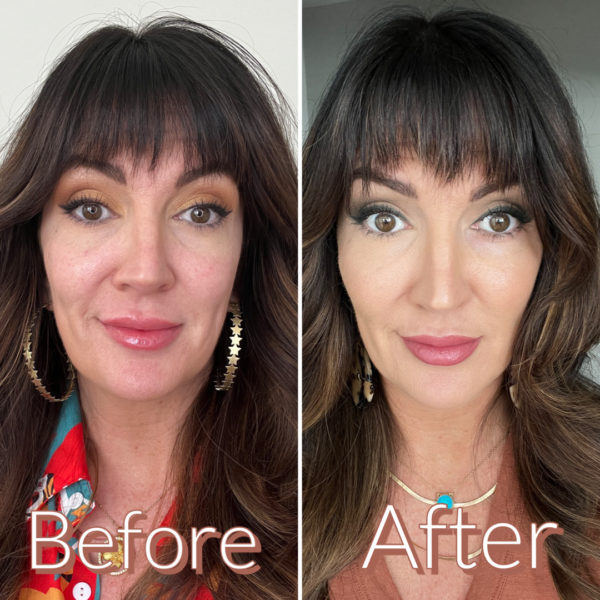 I Tried Cheek Filler For The First Time. Let’s Talk About It…