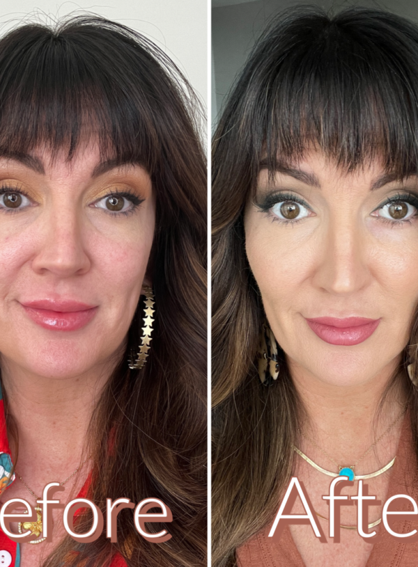 I Tried Cheek Filler For The First Time. Let’s Talk About It…